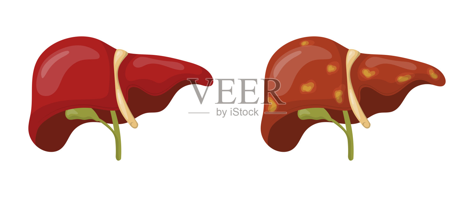 健康肝脏与脂肪肝的对比，代表肝硬化或肝病插画图片素材