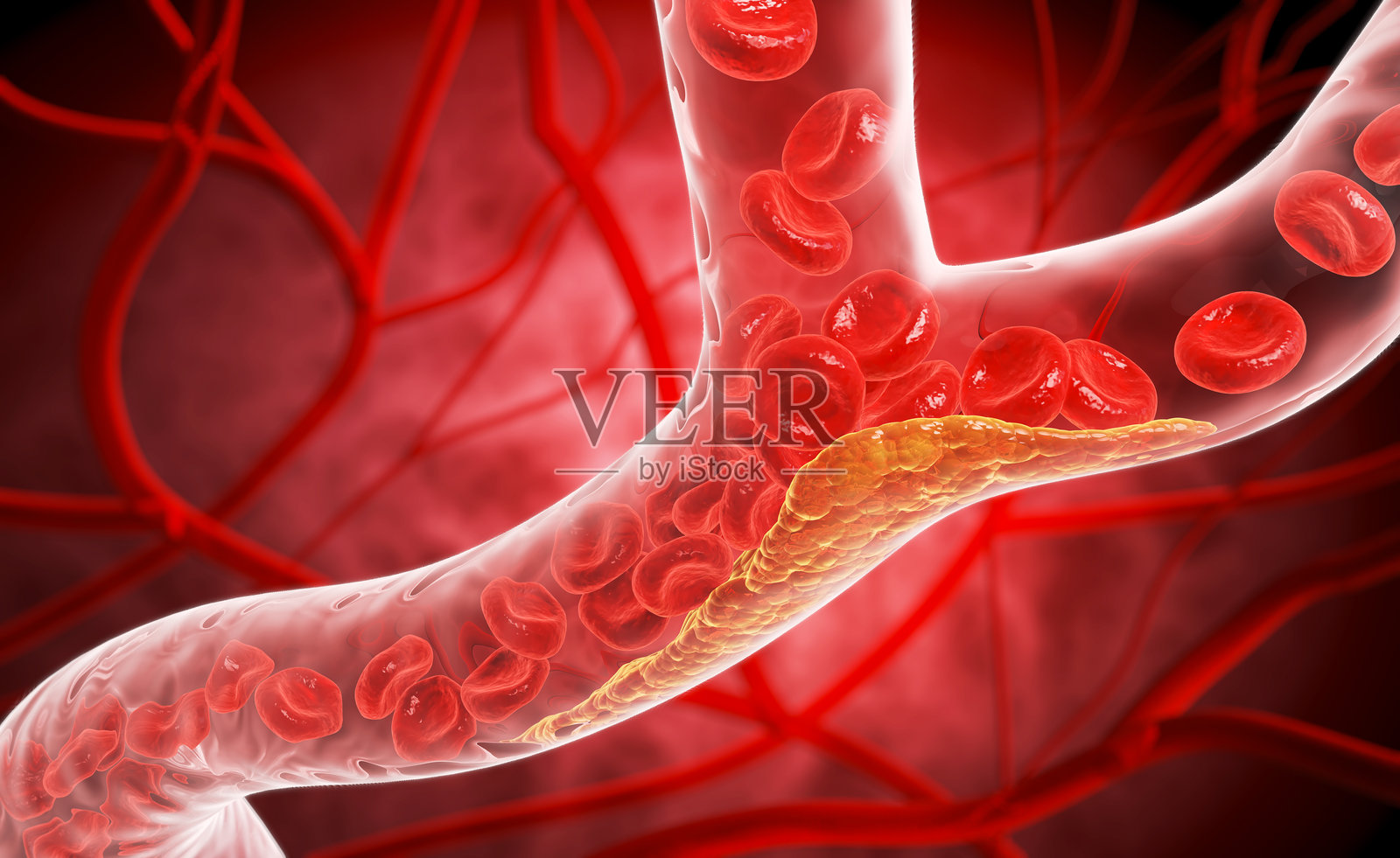 3D插图显示因斑块积聚而变窄的血管，限制血流，血液中高胆固醇的症状照片摄影图片