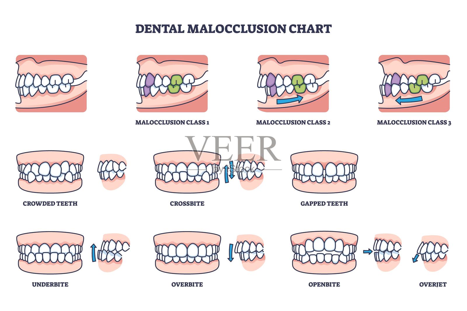 牙齿错位图表显示了牙齿不齐的类型，包括深覆合，...插画图片素材