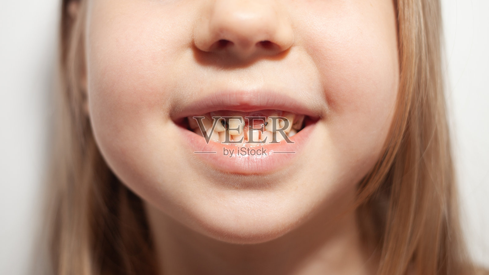 女孩近距离展示因缺乏卫生而腐烂的牙齿照片摄影图片