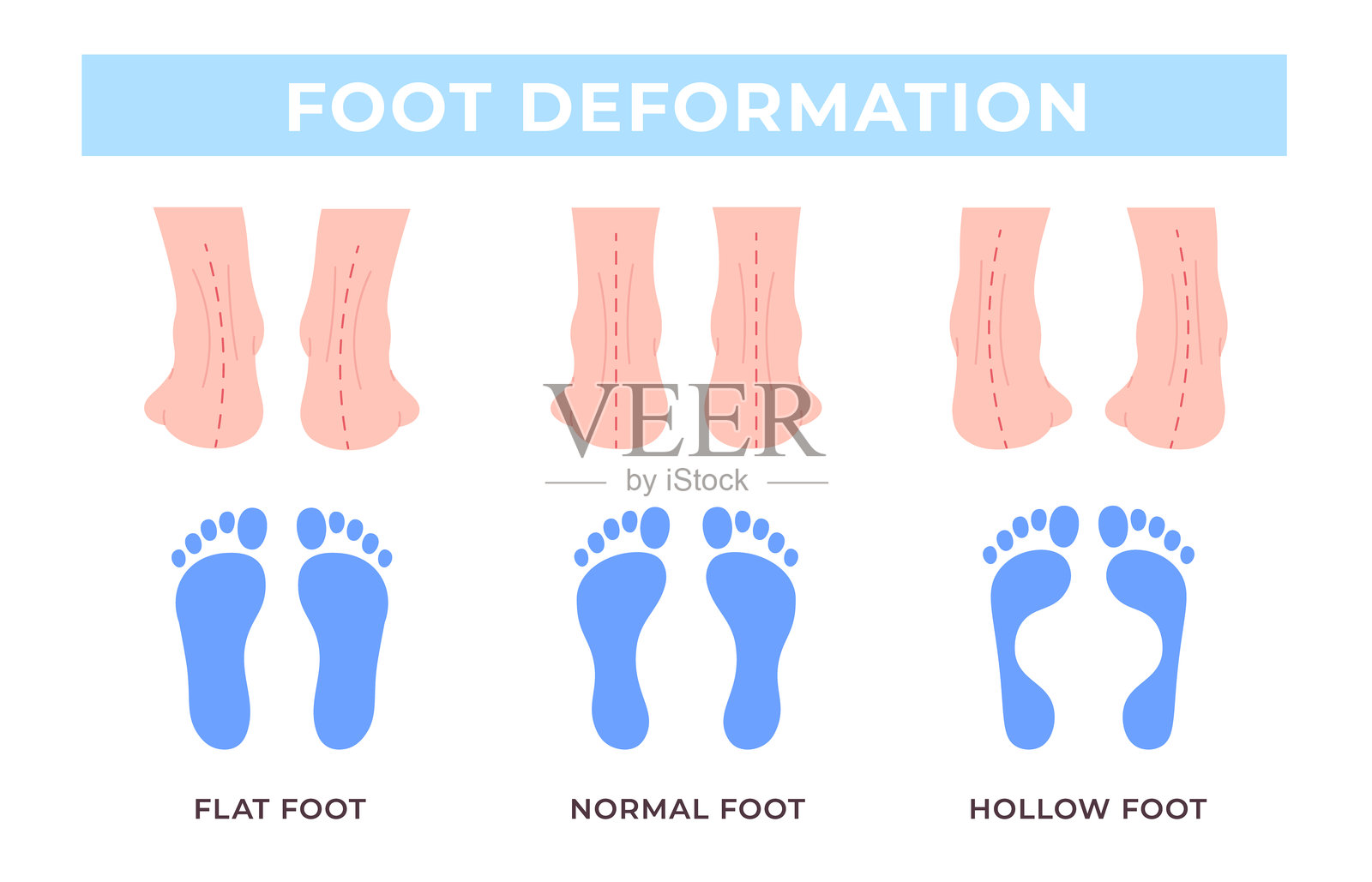 足部变形医学海报。足部弯曲类型，正常、扁平和高弓足。骨科疾病信息横幅，人体解剖，生动的矢量模板。插画图片素材