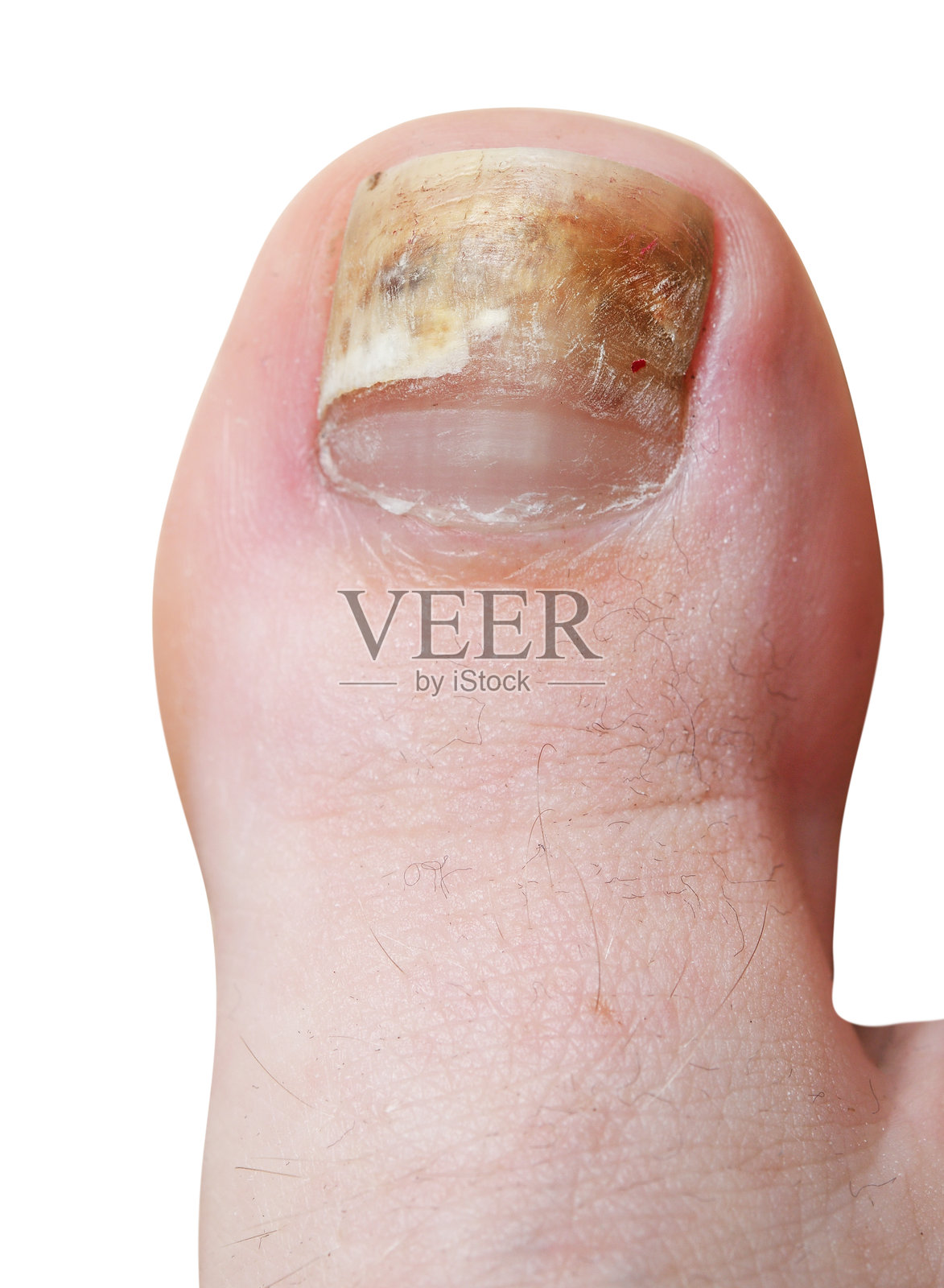 人类脚趾甲的真菌感染特写，背景为白色。照片摄影图片