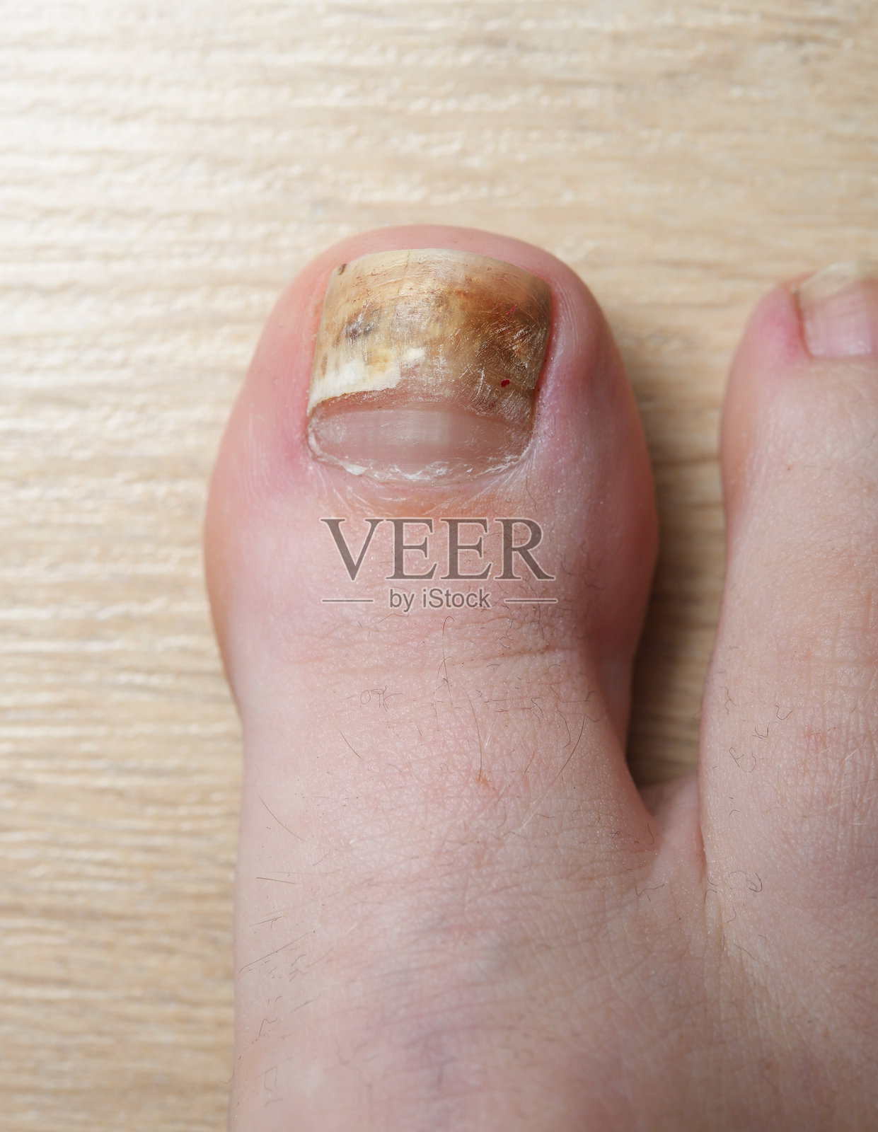 人脚趾甲真菌感染的特写视图照片摄影图片