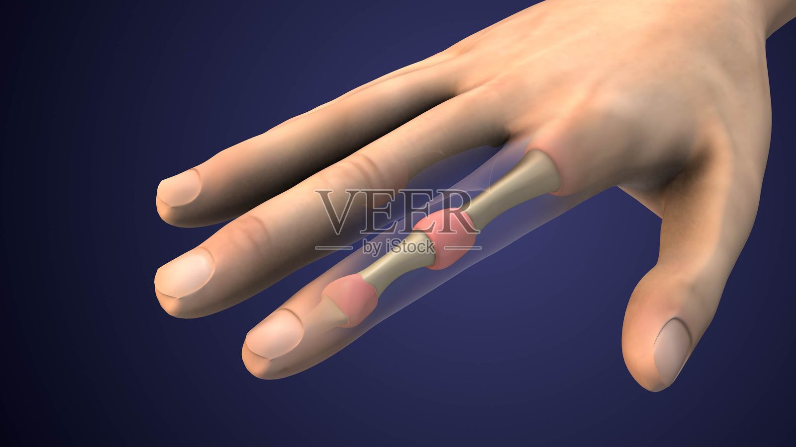 类风湿性关节炎导致的手部肿胀和僵硬疼痛照片摄影图片