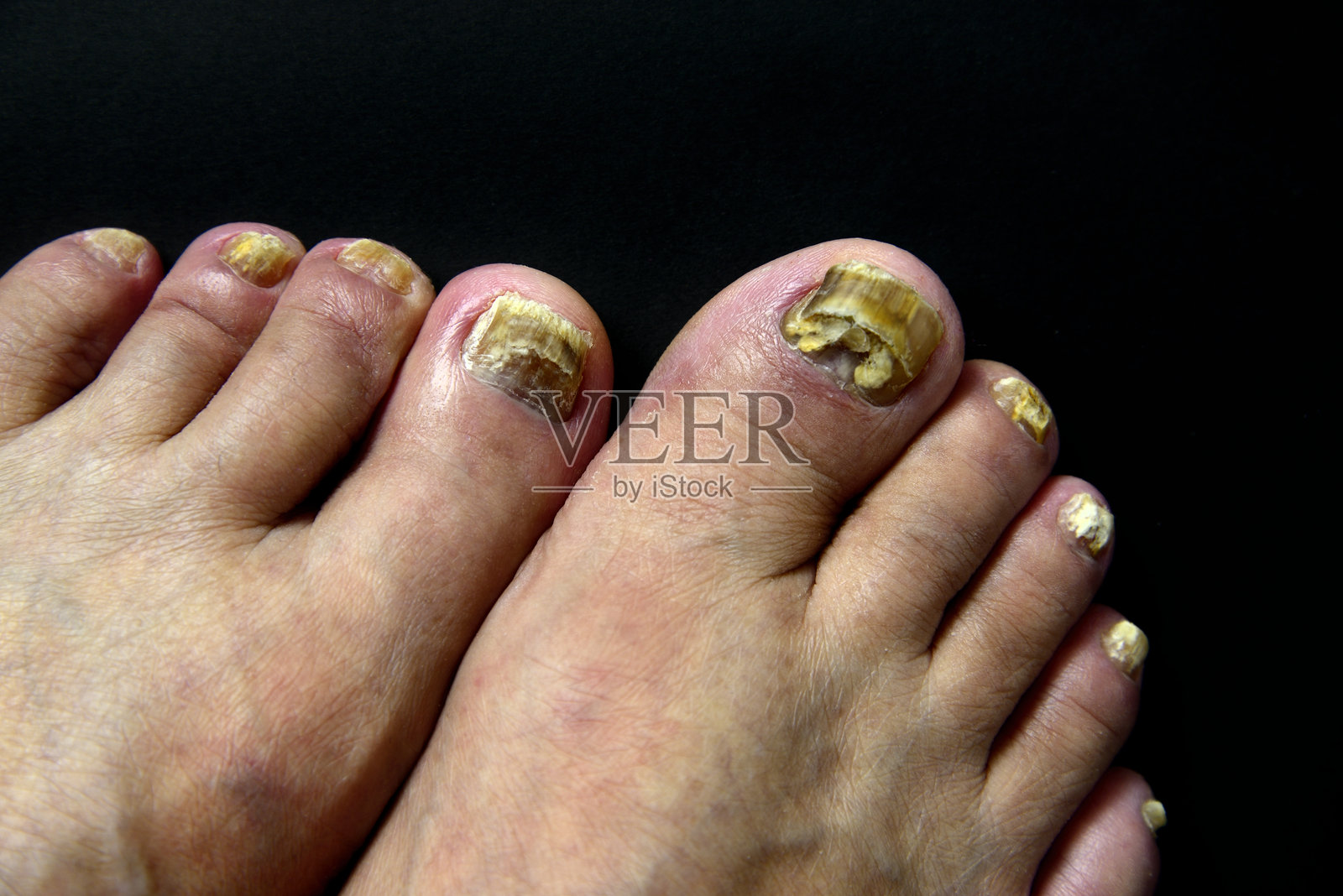 脚趾、手指、指甲、脚气照片摄影图片