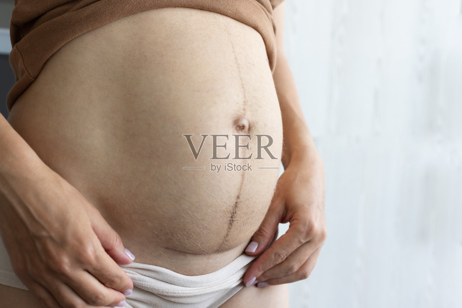 剖腹产后女性腹部的特写，显示伤疤。孩子出生后对缝合处的护理。照片摄影图片