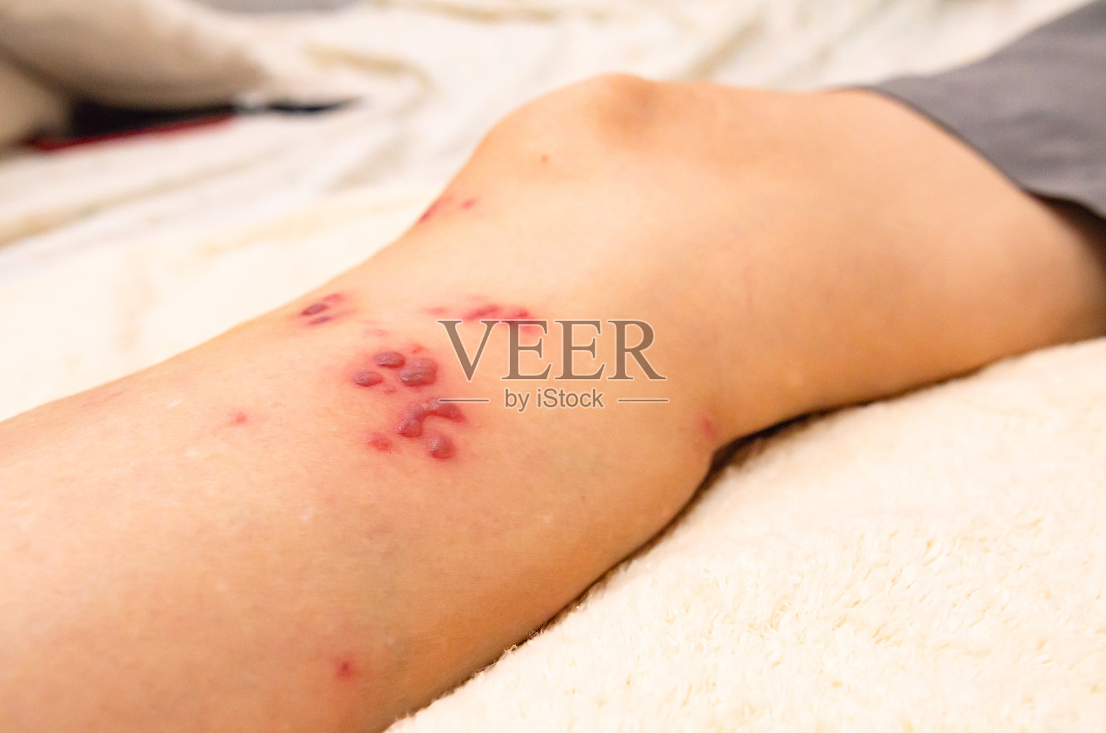 带有带状疱疹的女性，皮肤感染了带状疱疹病毒，医疗与健康。照片摄影图片