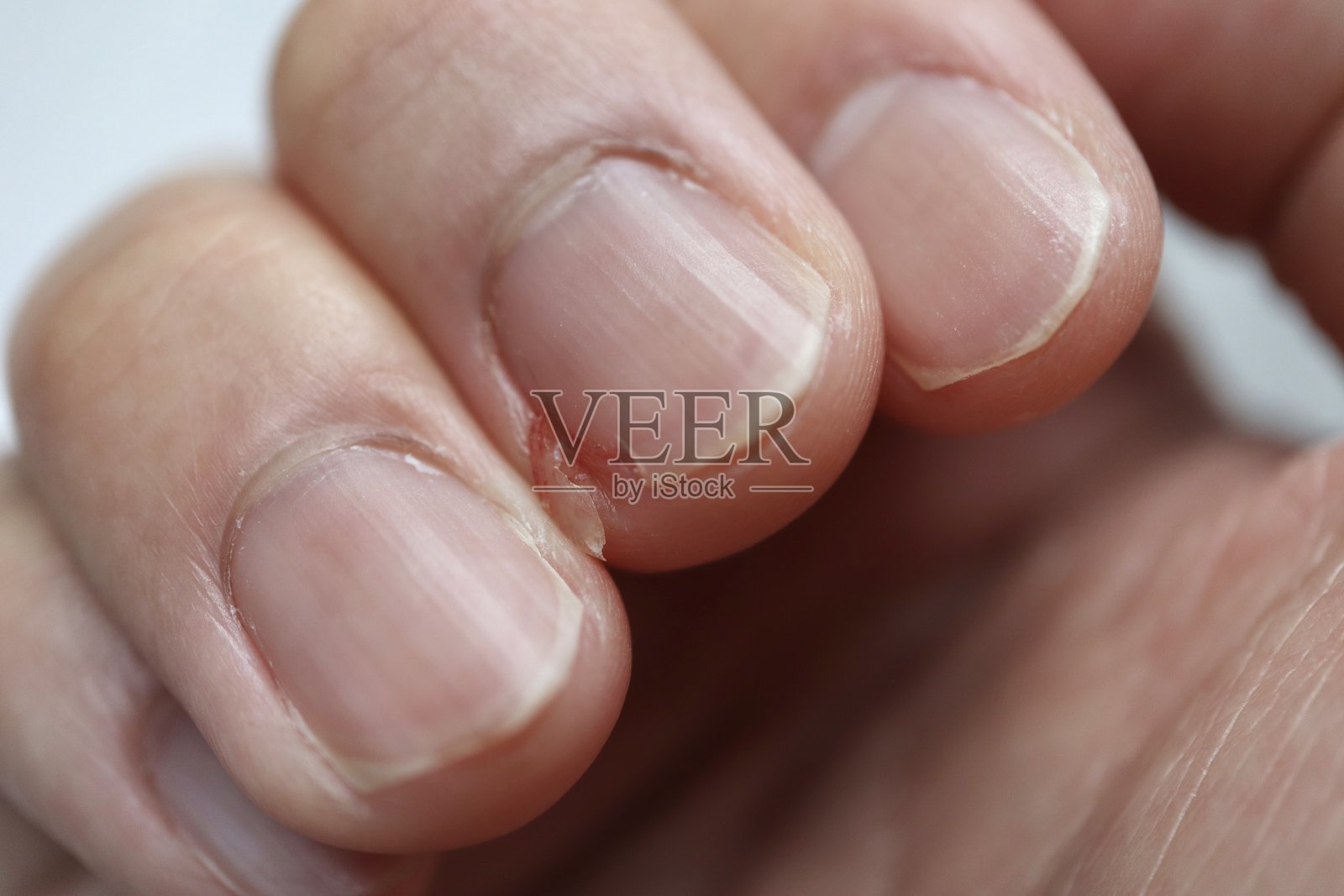 一个痛苦破损的中指指甲。照片摄影图片