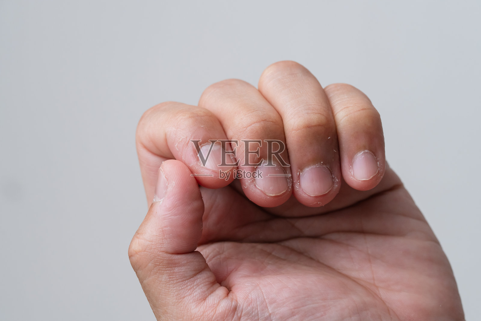 因焦虑症和皮肤撕扯（皮肤病强迫症）导致的受损指甲特写。照片摄影图片