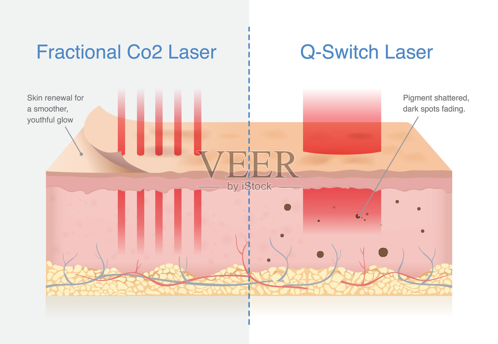 分段CO2激光与Q开关激光对皮肤层的影响。分段CO2激光换肤，促进更新，使皮肤更加光滑。Q开关激光打碎色素，淡化黑斑。插画图片素材
