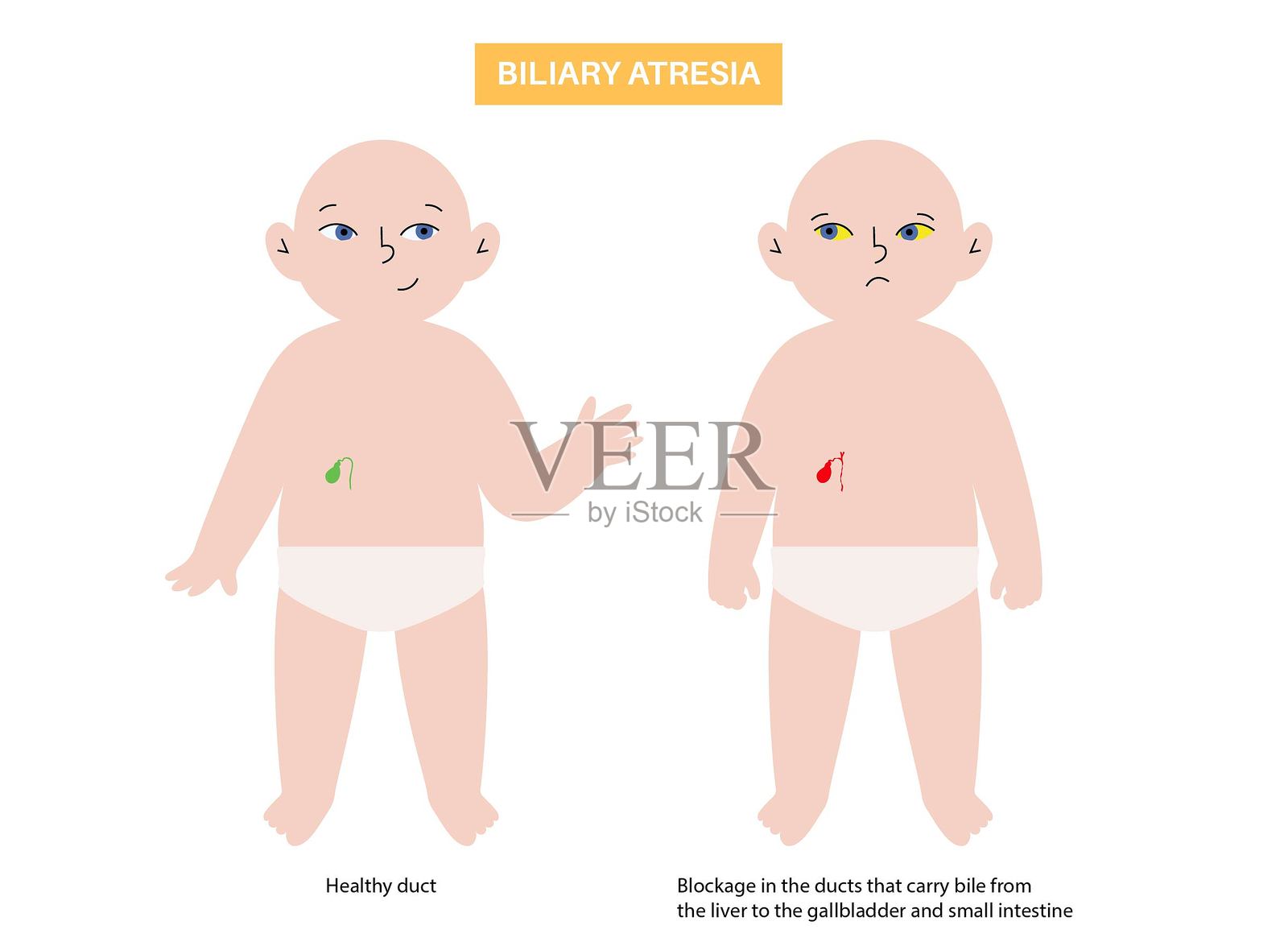 胆道闭锁病插画图片素材