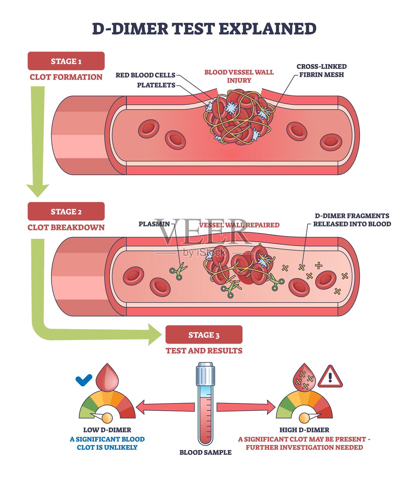 D-二聚体检测图显示血管损伤、血栓形成和...插画图片素材