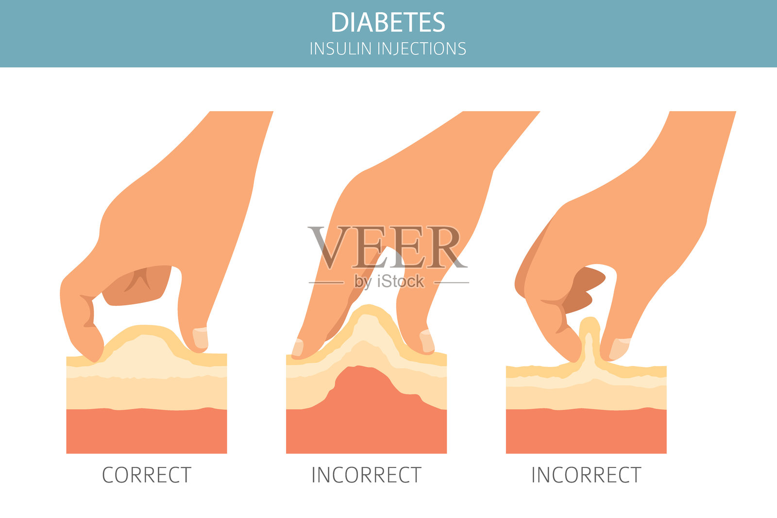 糖尿病。内分泌疾病。医学信息图设计插画图片素材