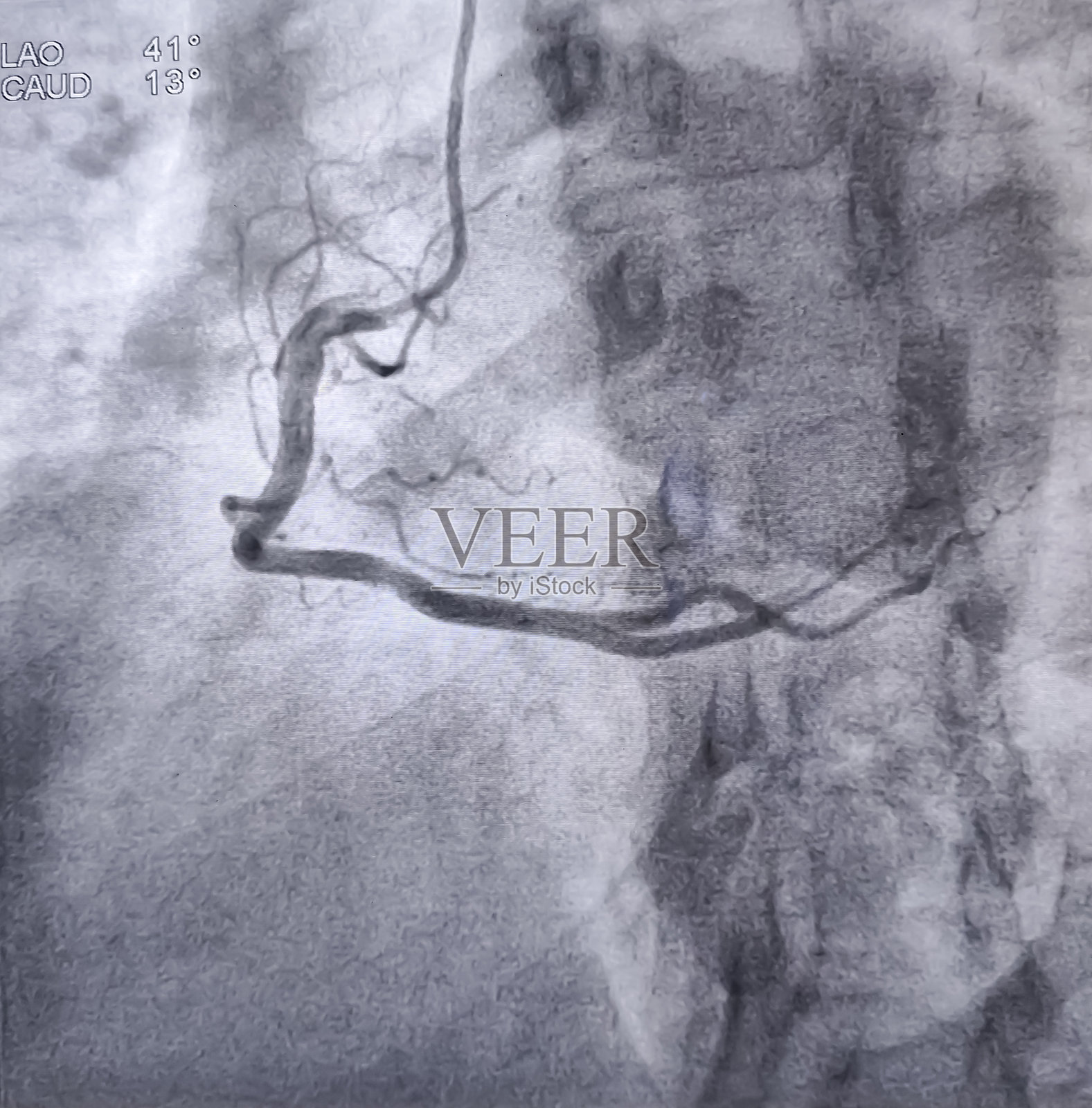 心导管检查期间右冠状动脉的冠状动脉造影，注射造影剂。发现异常。颜色调整。照片摄影图片