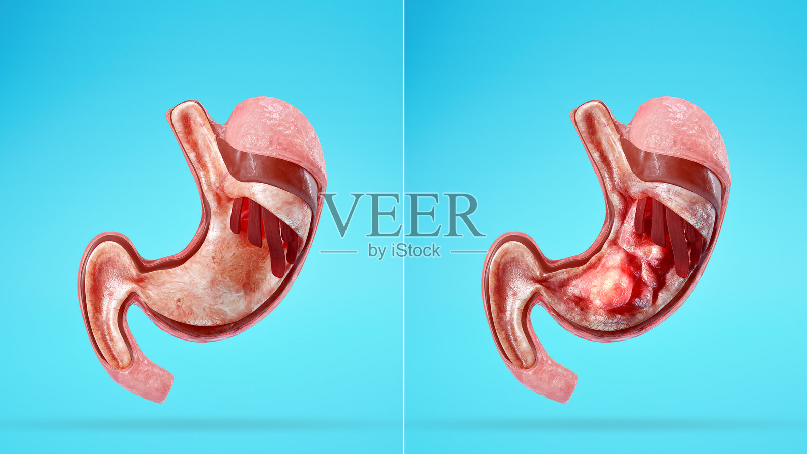 健康与患病胃对比 – 3D胃部医学解剖比较照片摄影图片