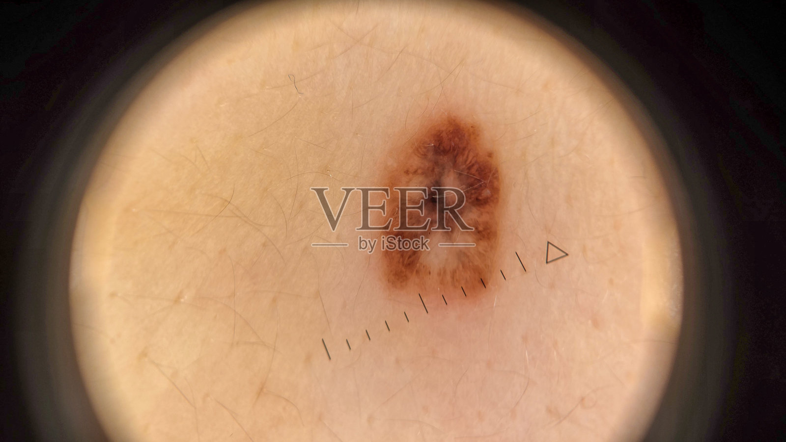 恶性黑色素瘤皮肤肿瘤的皮肤镜图像照片摄影图片