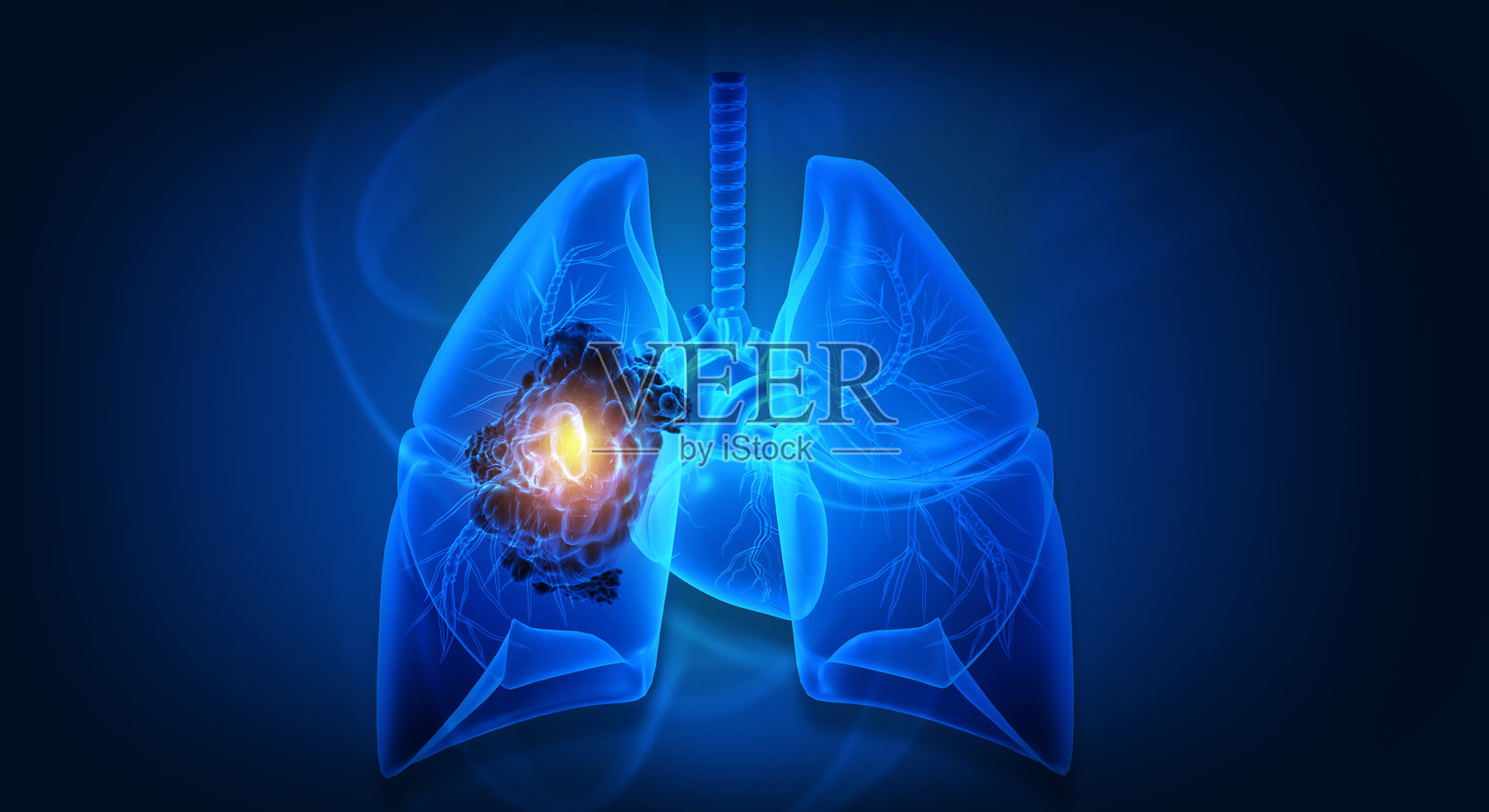 人类肺癌概念。组织异常增生照片摄影图片