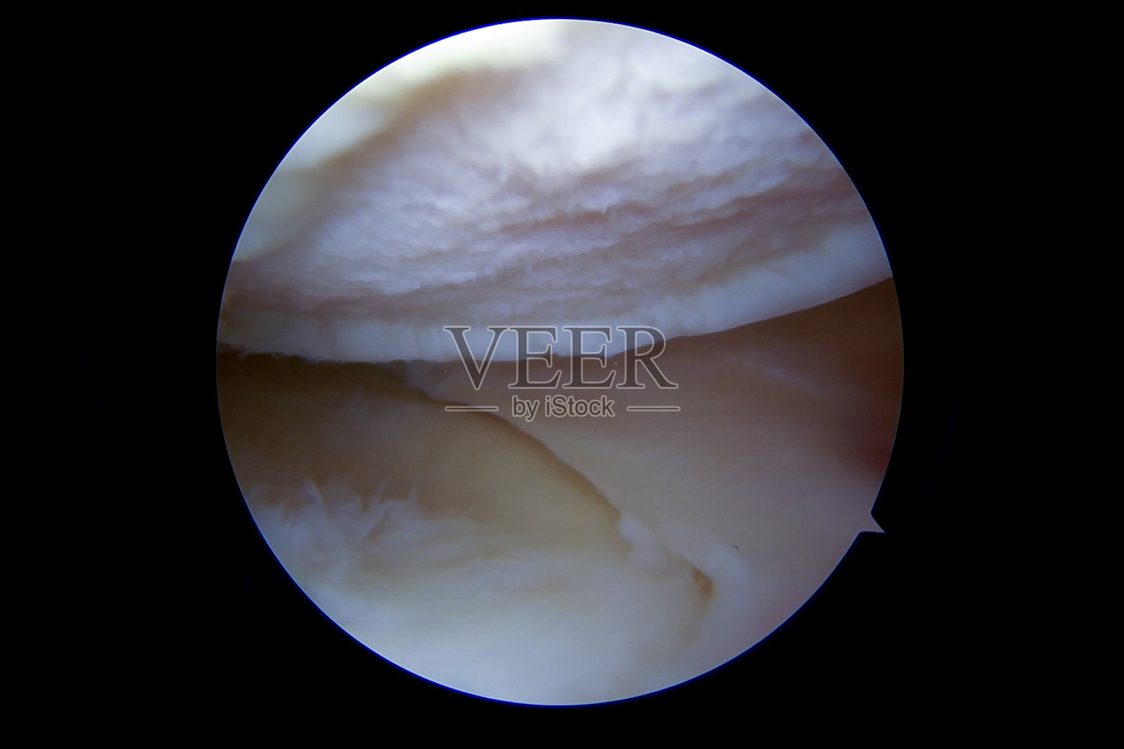 股骨内髁局灶性关节软骨缺损照片摄影图片