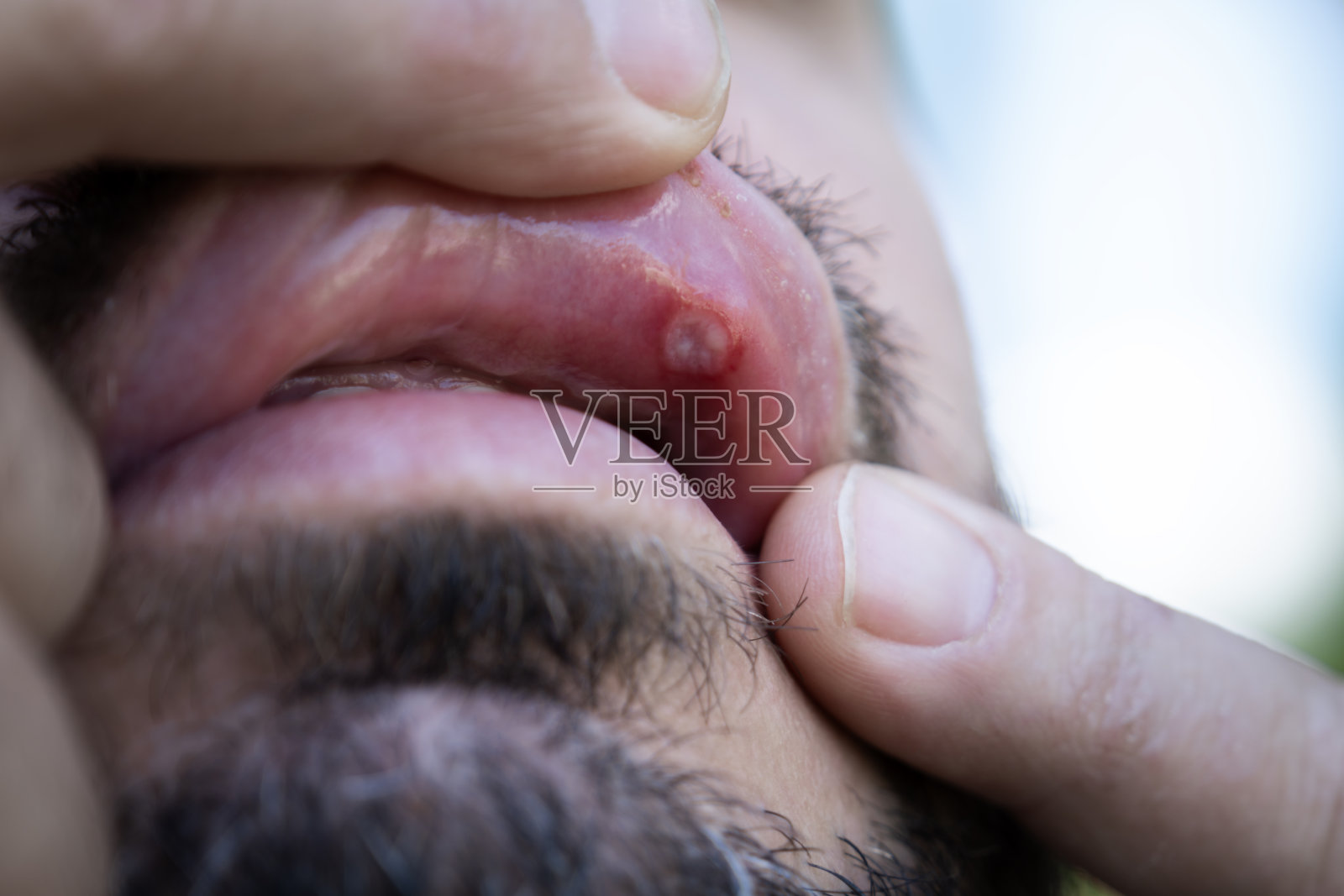 男子拉下下唇，露出内唇黏膜上疼痛的口腔溃疡，特写镜头显示红肿，口腔刺激，需要治疗或牙科护理照片摄影图片