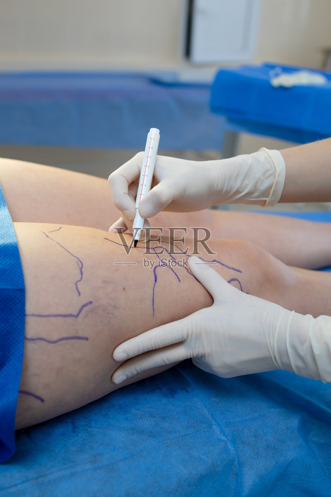 为静脉治疗计划在腿部绘制静脉标记。血管外科医生进行术前静脉描绘。照片摄影图片