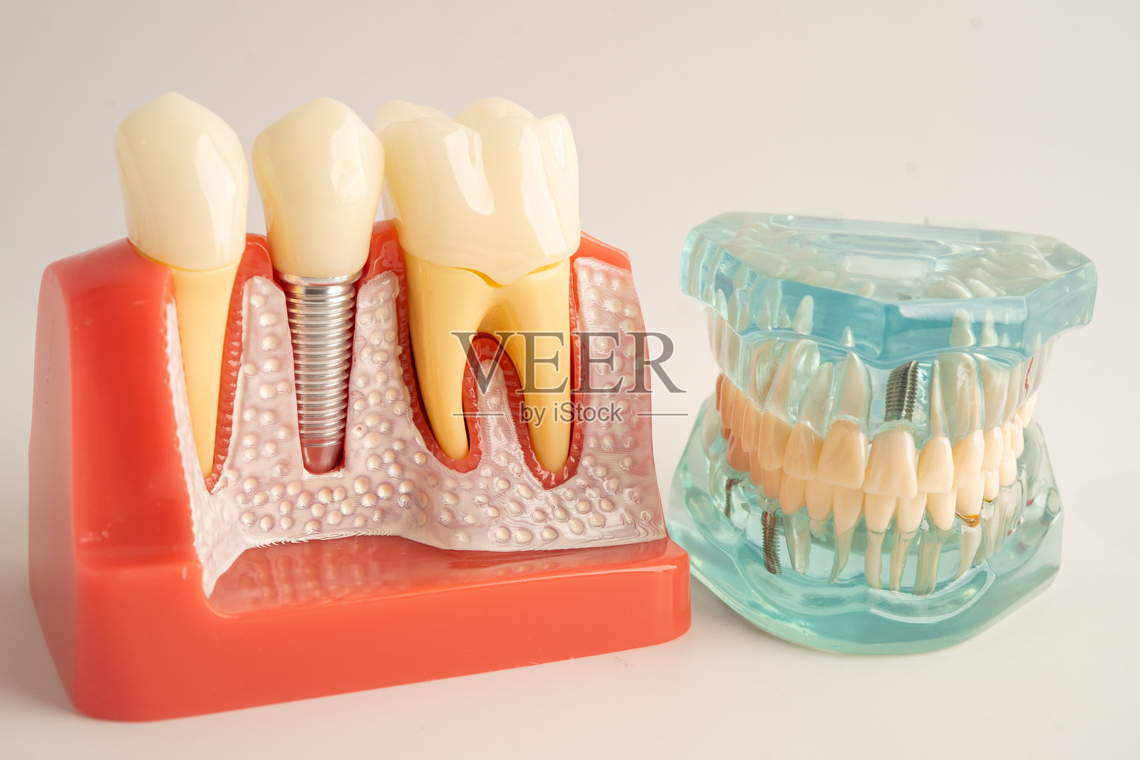 牙齿种植，将人造牙根植入颌骨，牙髓治疗的根管，牙龈疾病，供牙医研究的牙齿模型。照片摄影图片