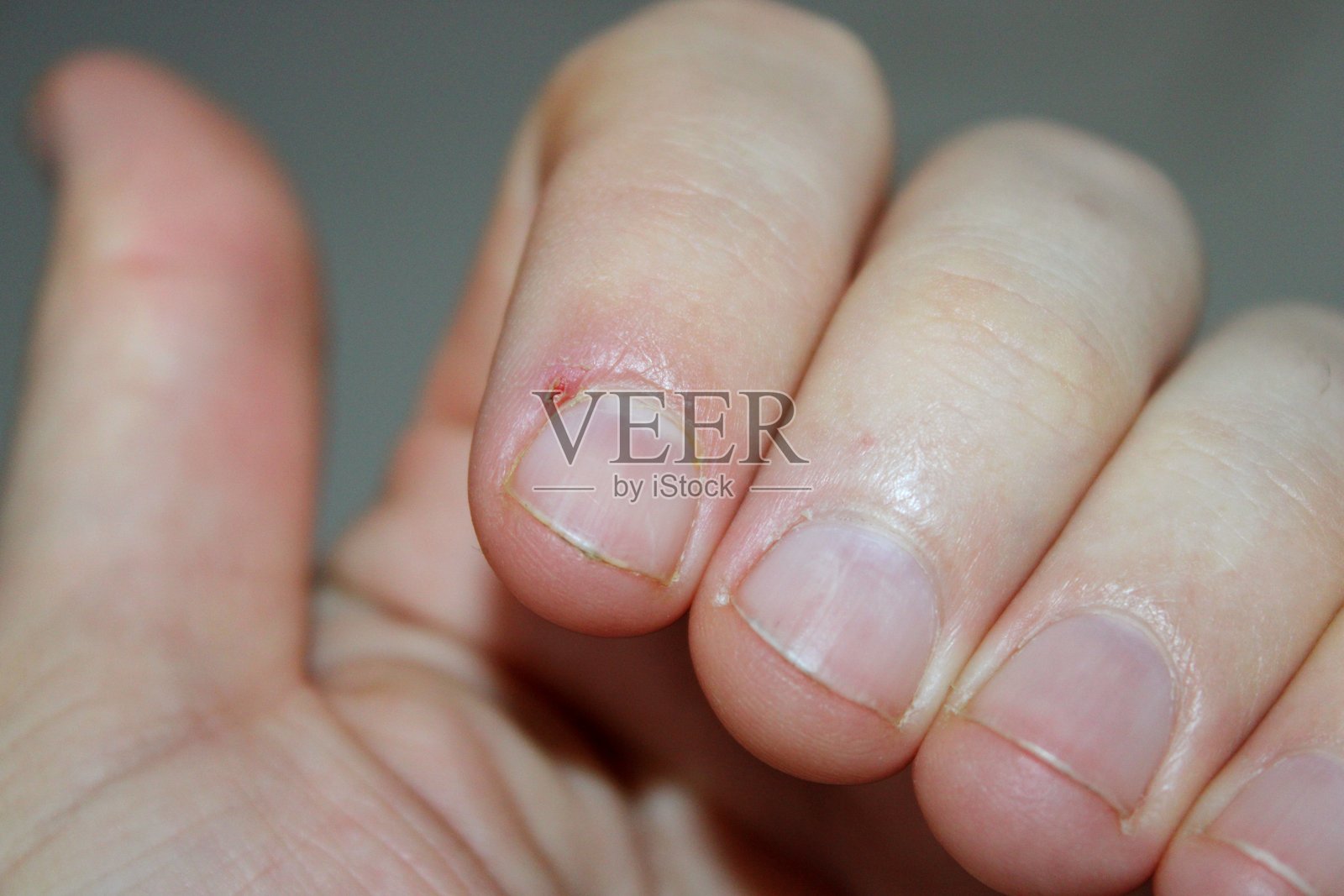 室内光线下，指甲附近小伤口的特写，可见皮肤和指甲细节照片摄影图片