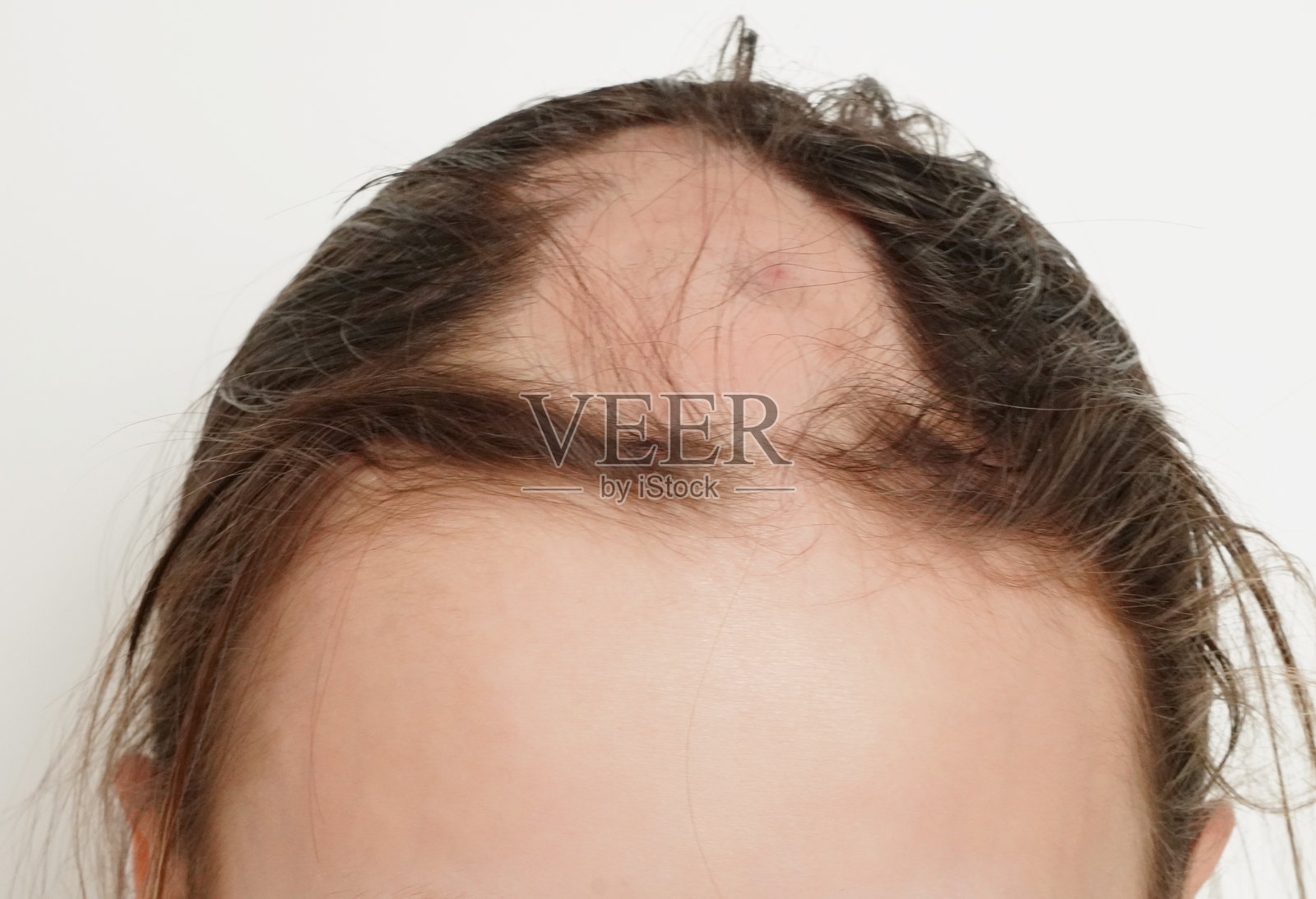 女性头皮脱发和斑秃照片摄影图片