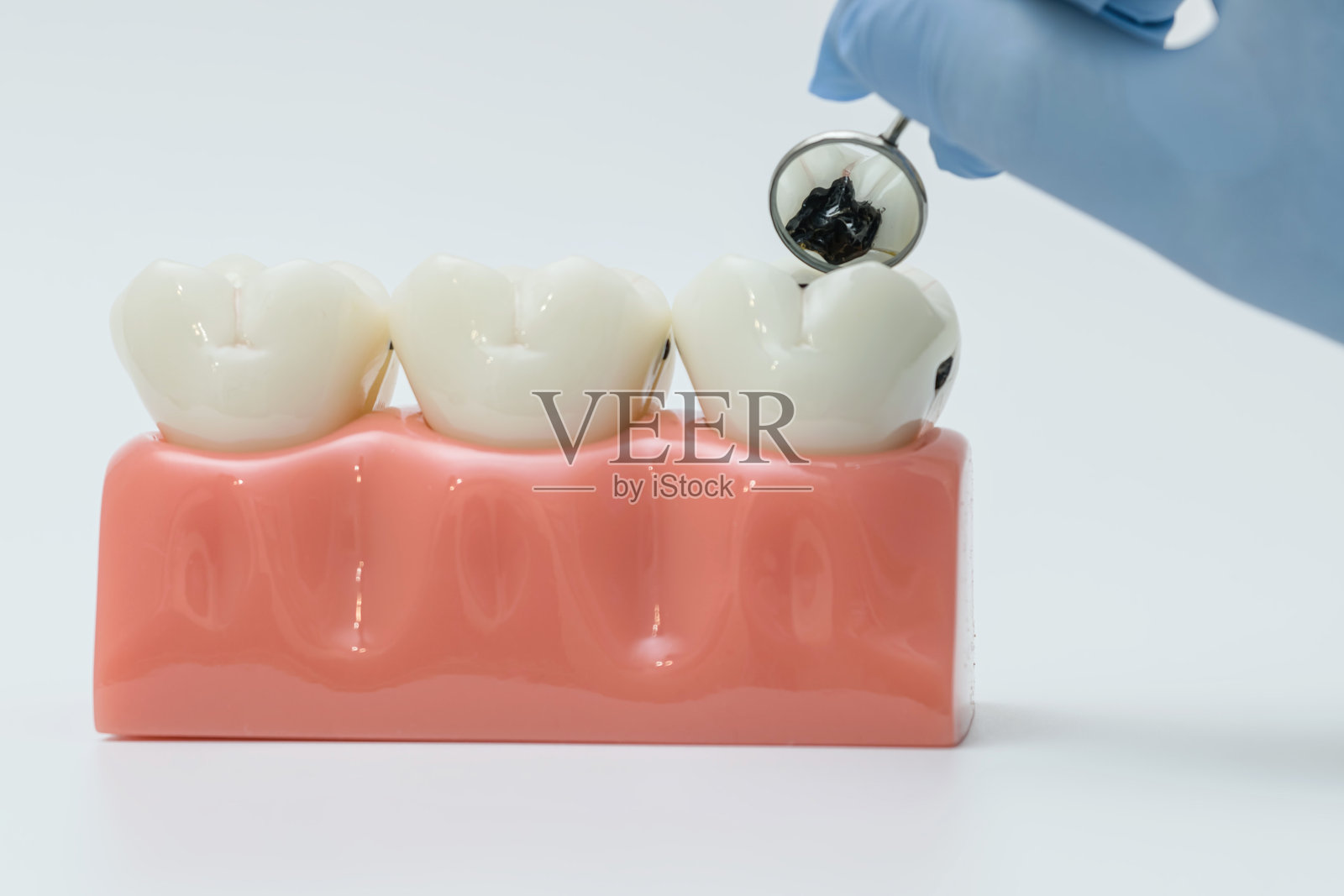 牙科镜检查模型上严重的牙齿腐烂照片摄影图片