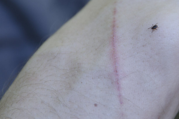 蜱虫在皮肤上行走图片下载