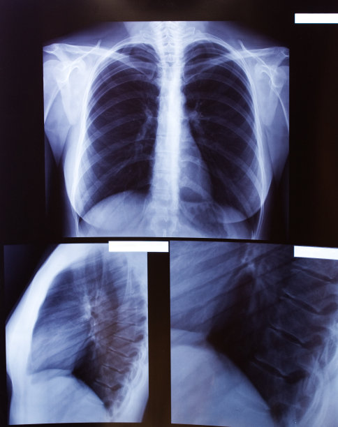 胸部x光片图片下载