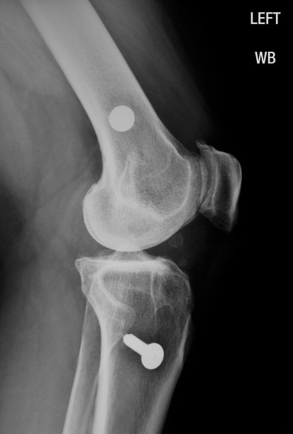 膝盖x光。图片下载