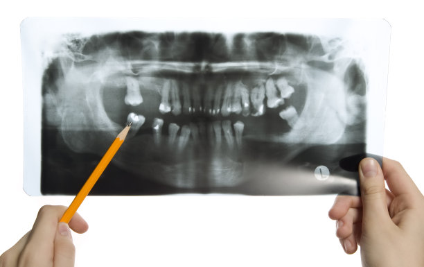 牙齿的伦琴照片图片下载