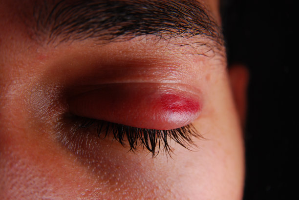 眼科手术图片下载