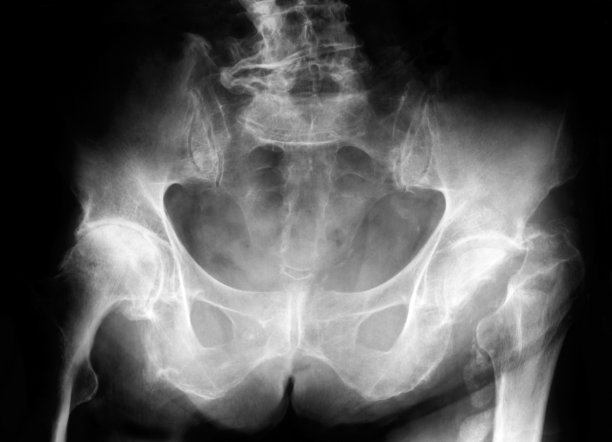 骨盆的x射线图片下载