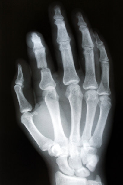 手指骨折图片下载