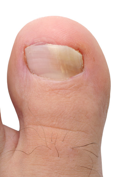 真菌感染图片下载