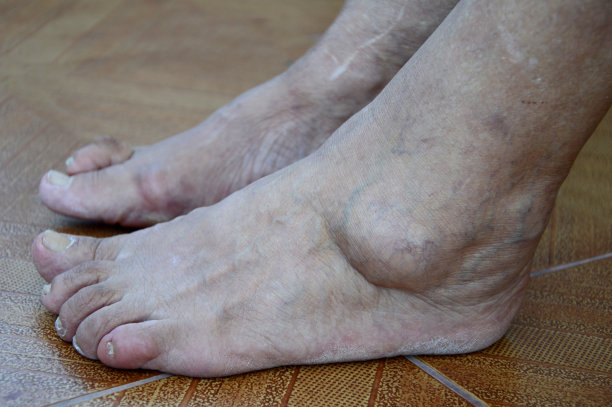 脚与滑膜炎图片下载