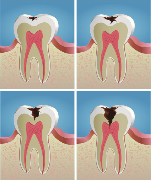 显示牙齿腐烂过程的图像图片下载
