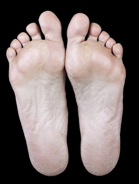 一个长满老茧的女人的脚图片下载