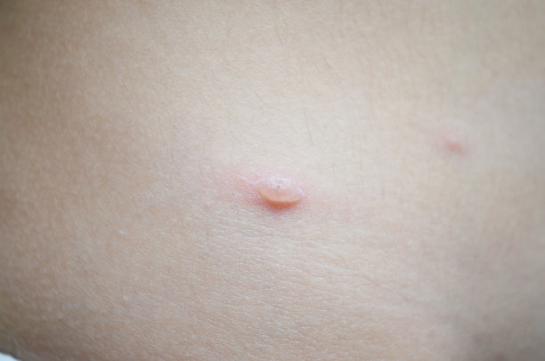 背部有水痘素材图片