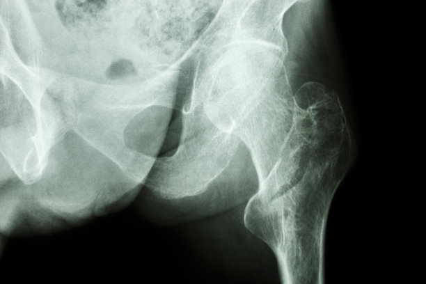 左股骨粗隆间骨折图片下载