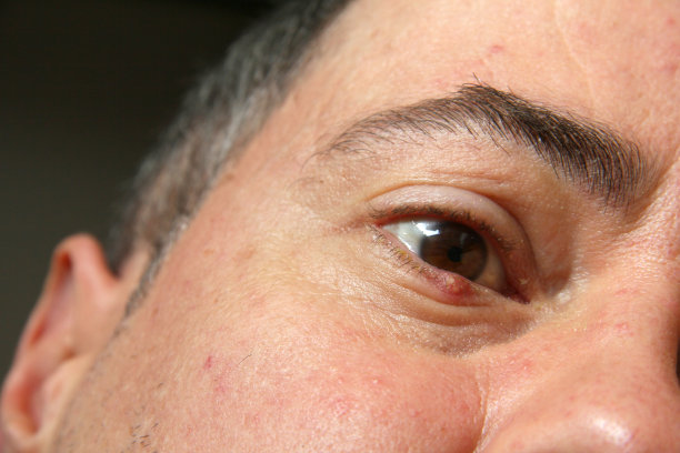 睑腺炎图片下载