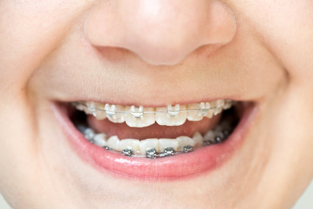 十几岁的男孩正在展示他的牙套图片下载