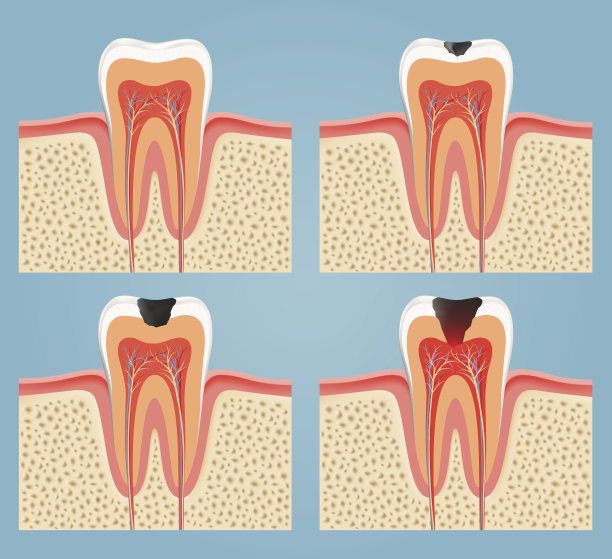 蛀牙的阶段图片下载