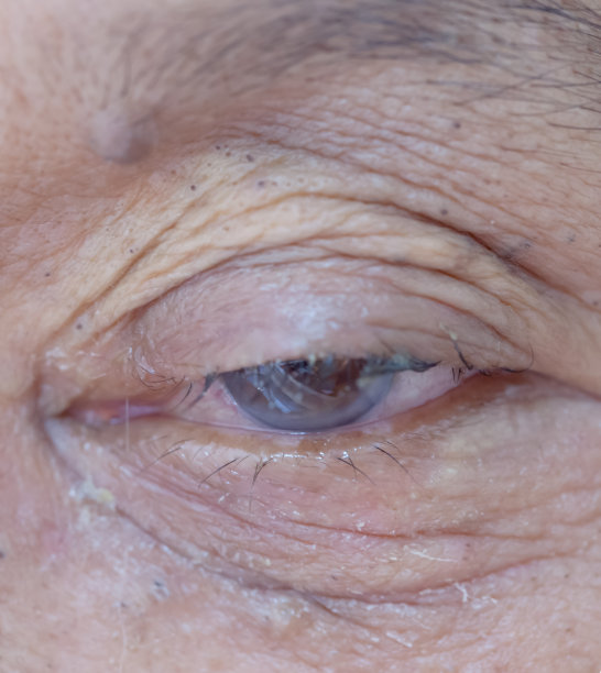 老年白内障眼患者亚洲妇女图片下载