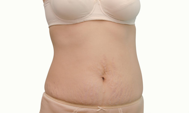 显示妊娠纹的女人图片下载