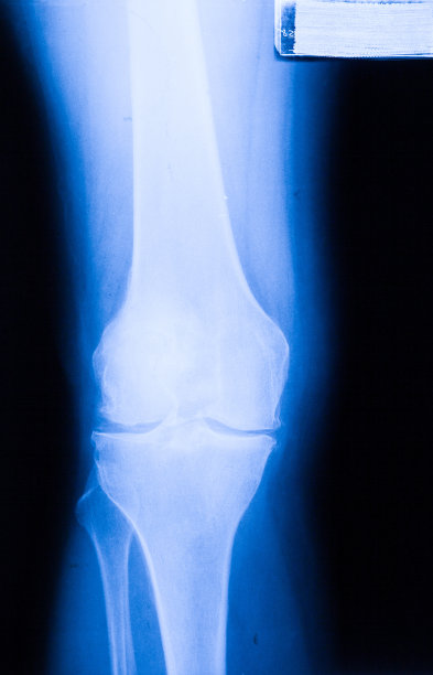 踝关节、脚部及膝关节x光照片图片下载