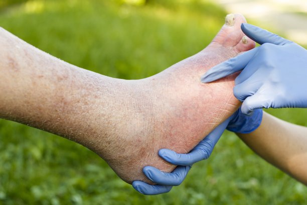 动脉硬化的老脚图片下载