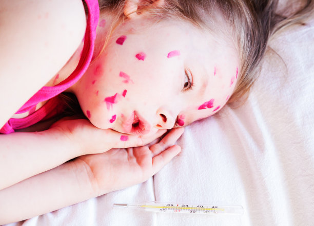 这个女孩患了水痘图片下载