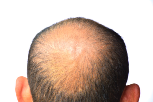 头发脱落的人，他的头上光秃秃的图片下载